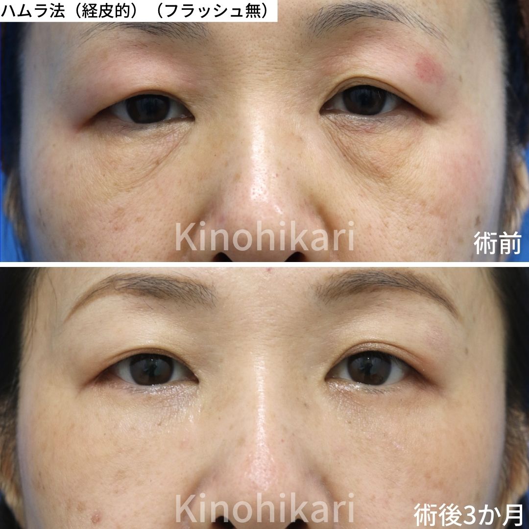 【経皮的ハムラ】目の下の皮膚のたるみの強い　40代女性【症例No.29Y0000792】