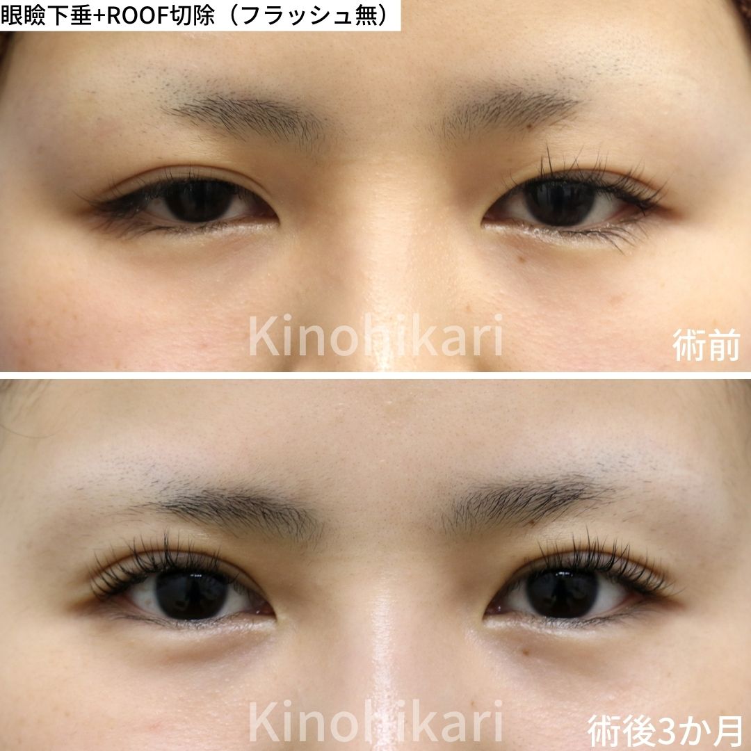 【眼瞼下垂＋ROOF切除】「目の開き＋ぶ厚い上まぶた」を療法改善したい　20代女性【症例No.29Y0000794】