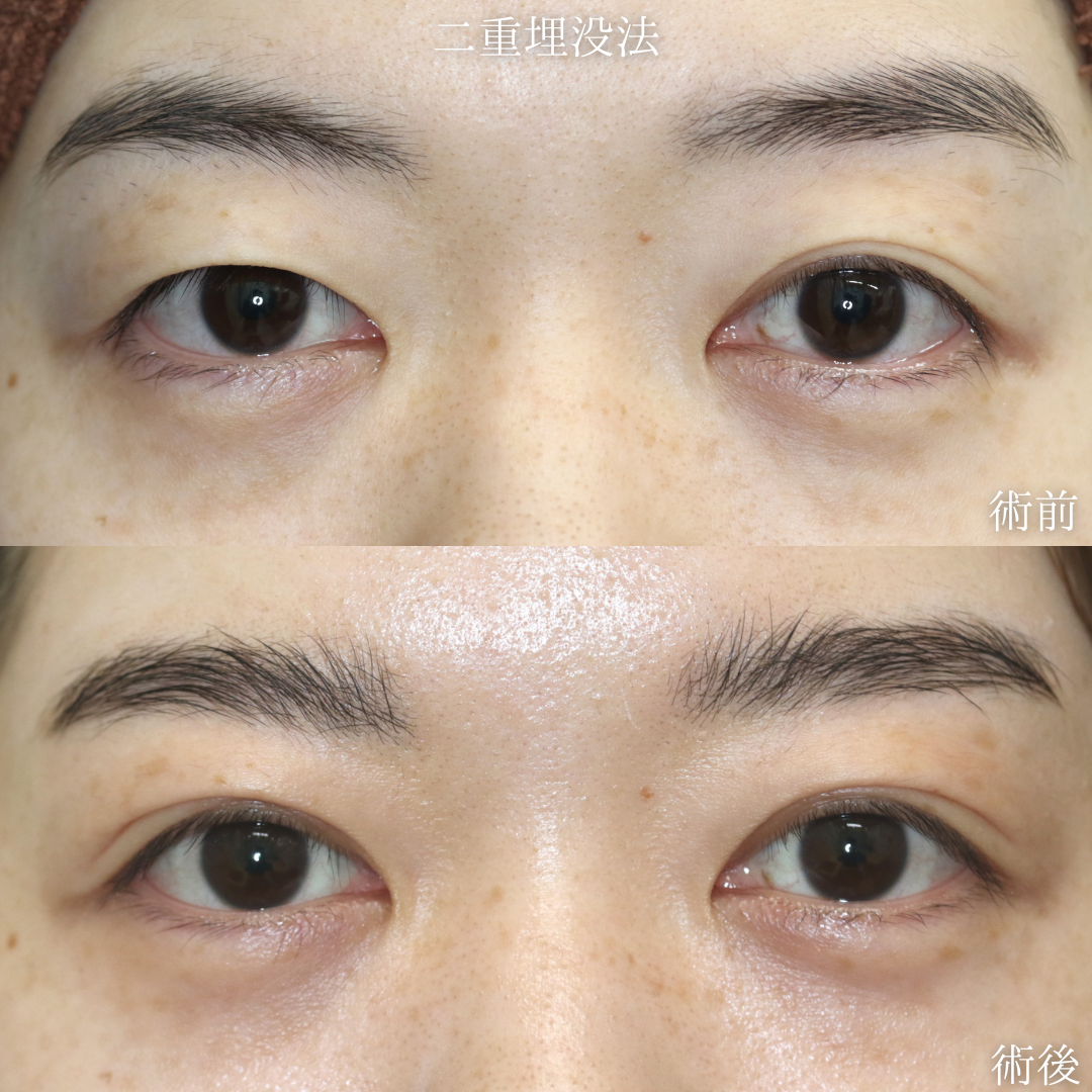 【二重埋没法】片目の一重で、左右非対称を改善したい　30代女性【症例No.29Y0000963】