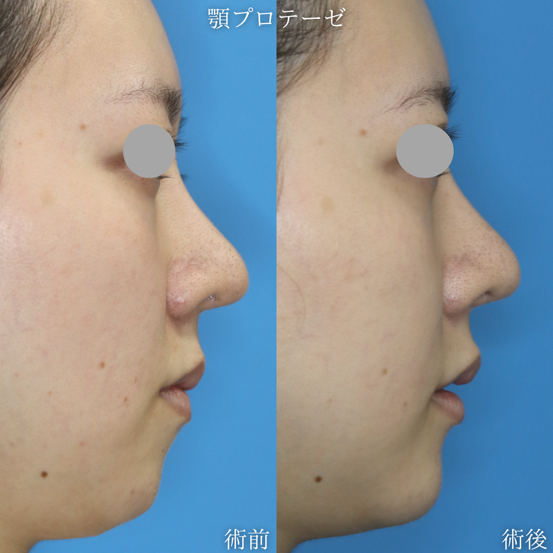 【顎プロテーゼ】顎を前に出したい　20代女性【症例No.29Y0000962】