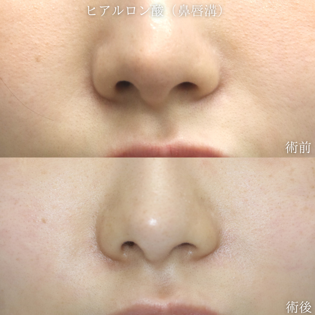 【ヒアルロン酸（鼻唇溝）】鼻翼基部が埋まって見える　20代女性【症例No.29Y0000961】