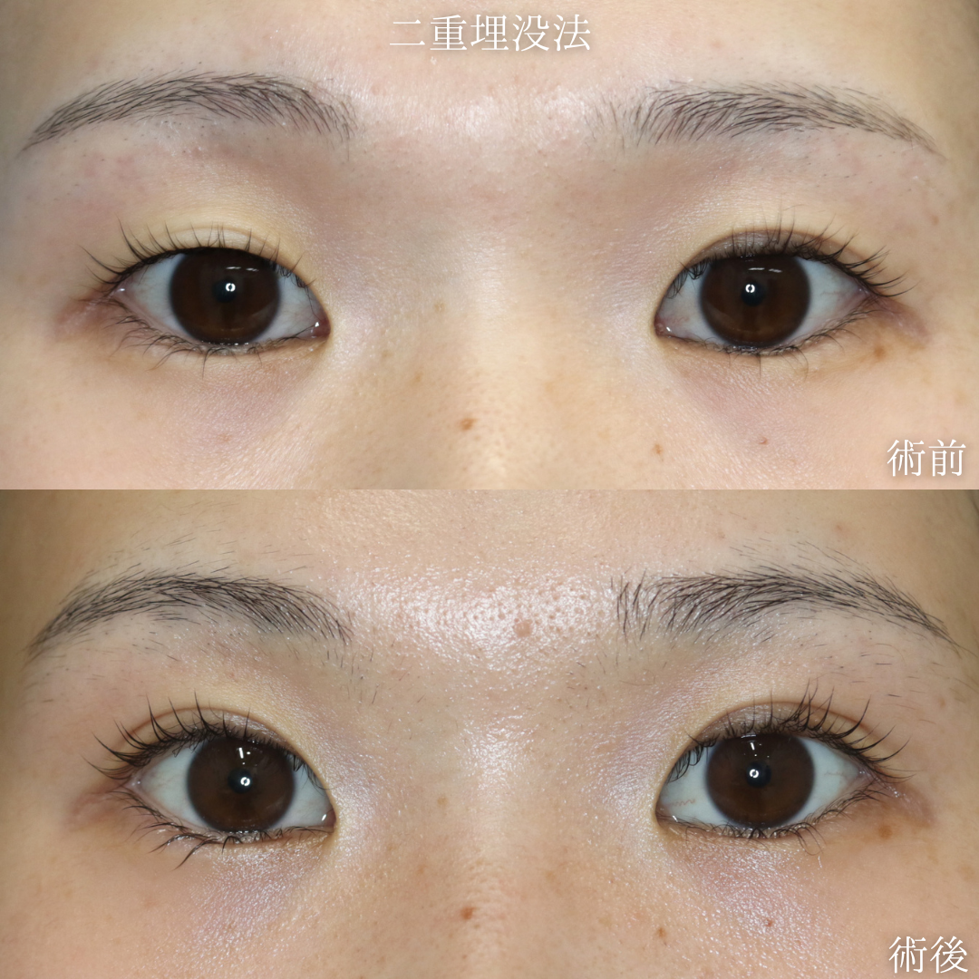 【二重埋没法】右目の浅い二重を改善したい　20代女性【症例No.29Y0000964】