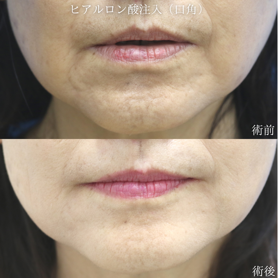 【ヒアルロン酸】口角から輪郭にかけてのシワ(マリオネットライン)が気になる　50代女性【症例No.29Y0000966】