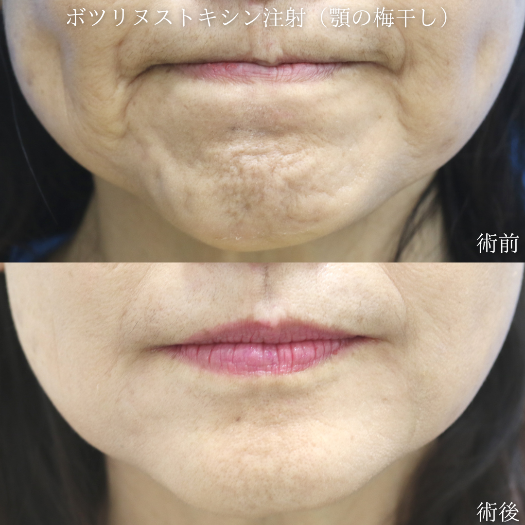 【あご梅干しジワ】あごの梅干しジワが気になる　50代女性【症例No.29Y0000967】