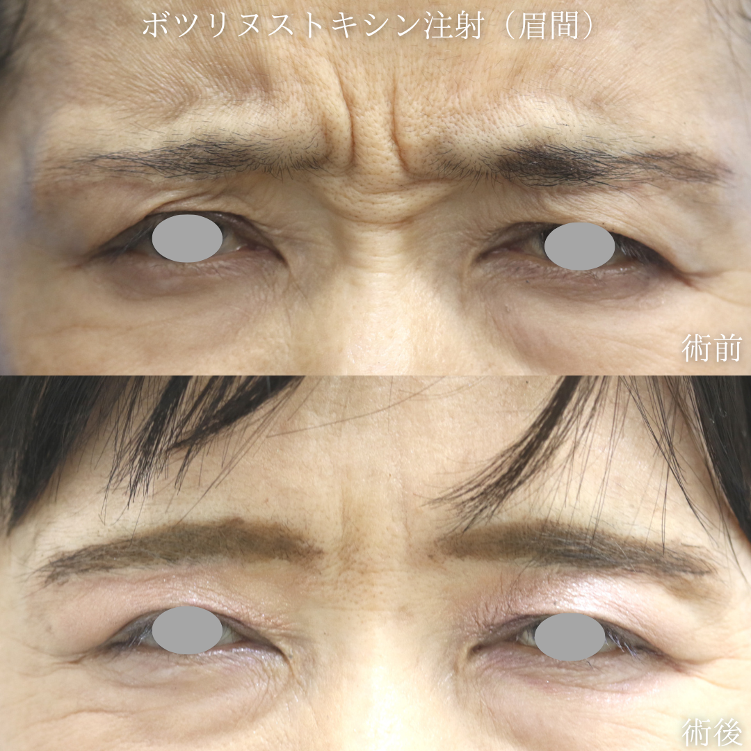 【眉間のしわ】眉間のシワが気になる　50代女性【症例No.29Y0000968】