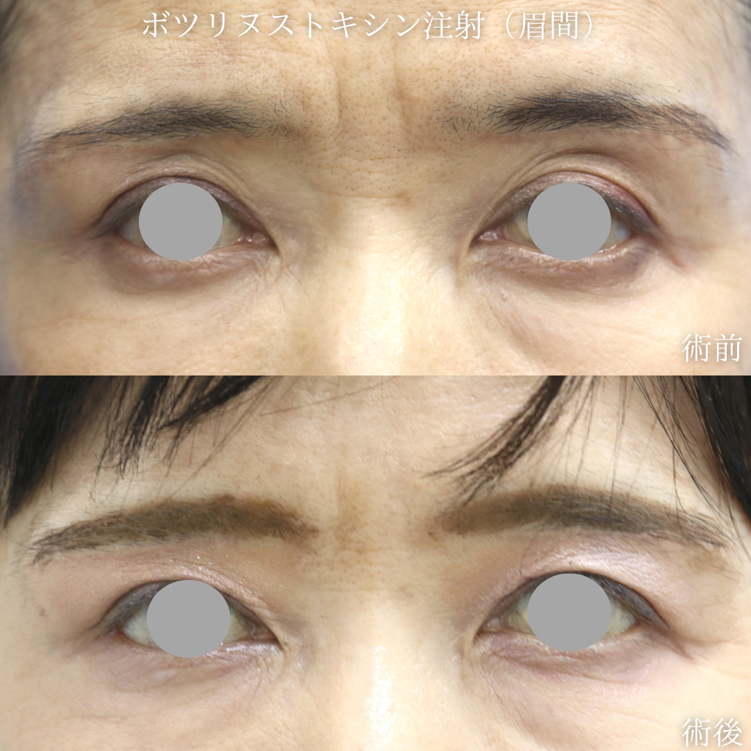 【眉間のしわ】眉間のシワが気になる　50代女性【症例No.29Y0000968】