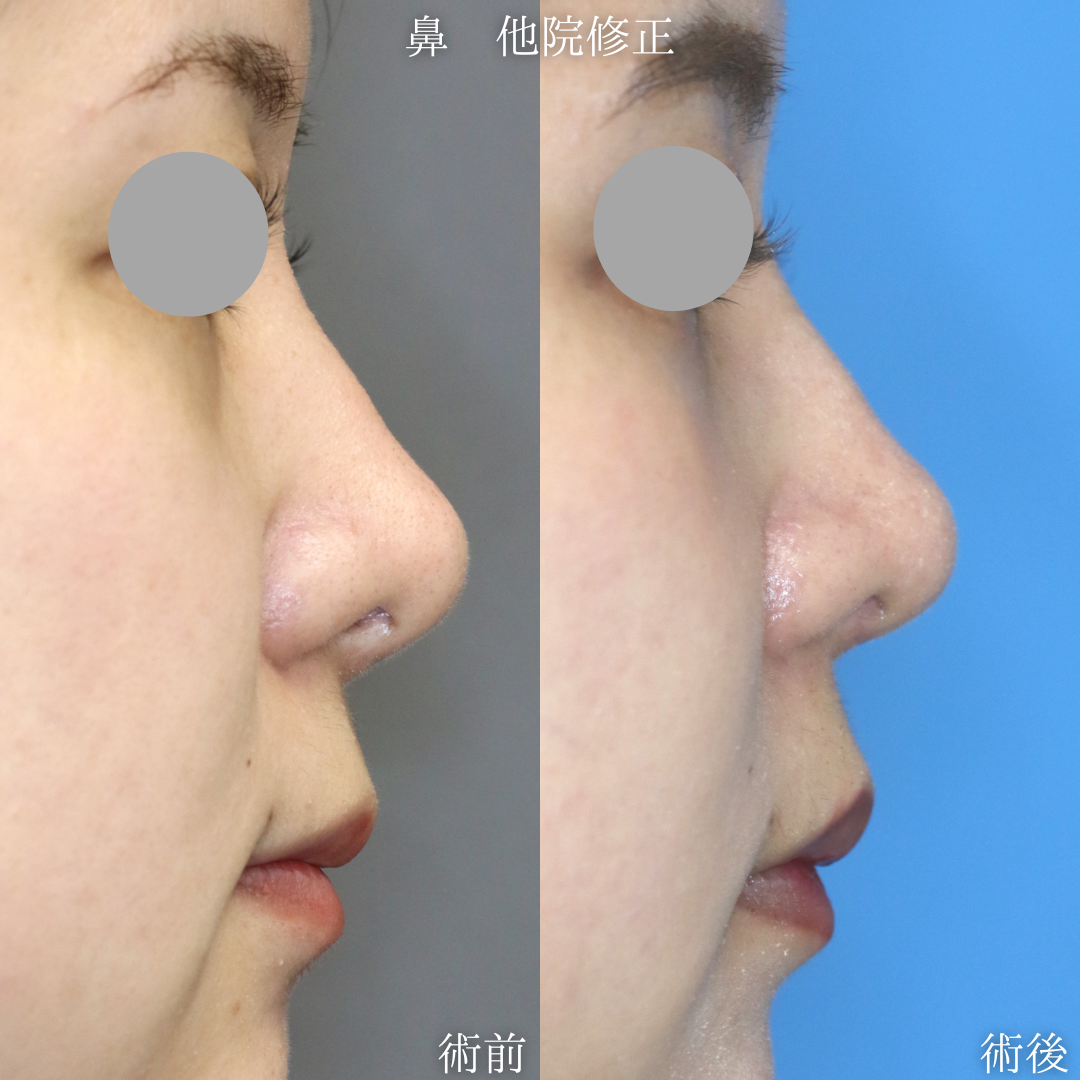 【他院術後】鼻尖縮小？術後の長過ぎる鼻柱を短くしたい30代女性【症例No.29Y0000969】