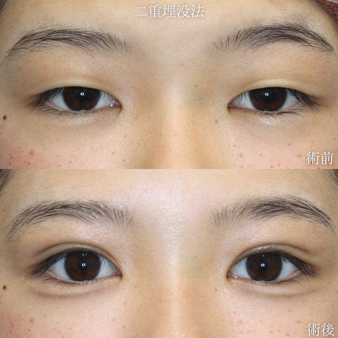 【二重埋没法】アイプチが決まらない　10代女性【症例No29Y0000970】