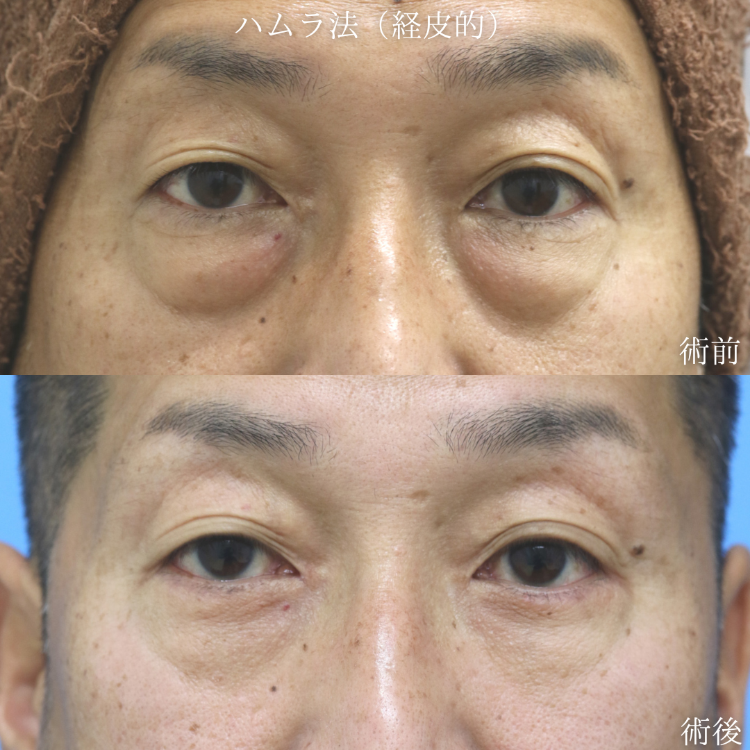 【経皮的ハムラ】目の下のクマに悩む　40代男性【症例No.29Y0000974】