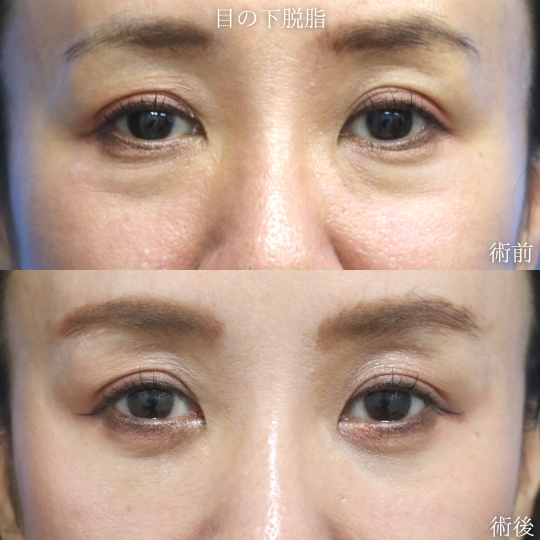 【目の下脱脂】切らないクマ改善を希望　40代女性【症例No.29Y0000973】