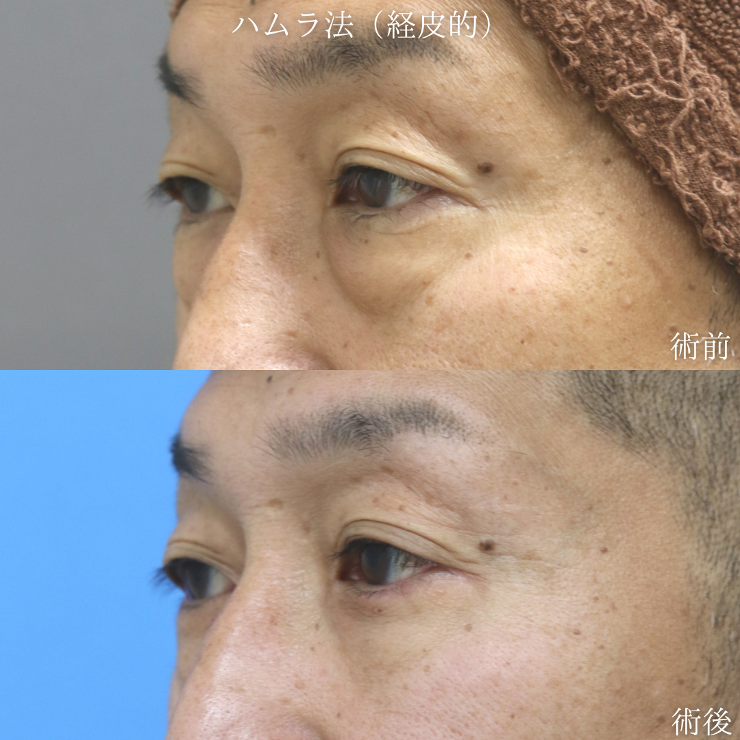 【経皮的ハムラ】目の下のクマに悩む　40代男性【症例No.29Y0000974】