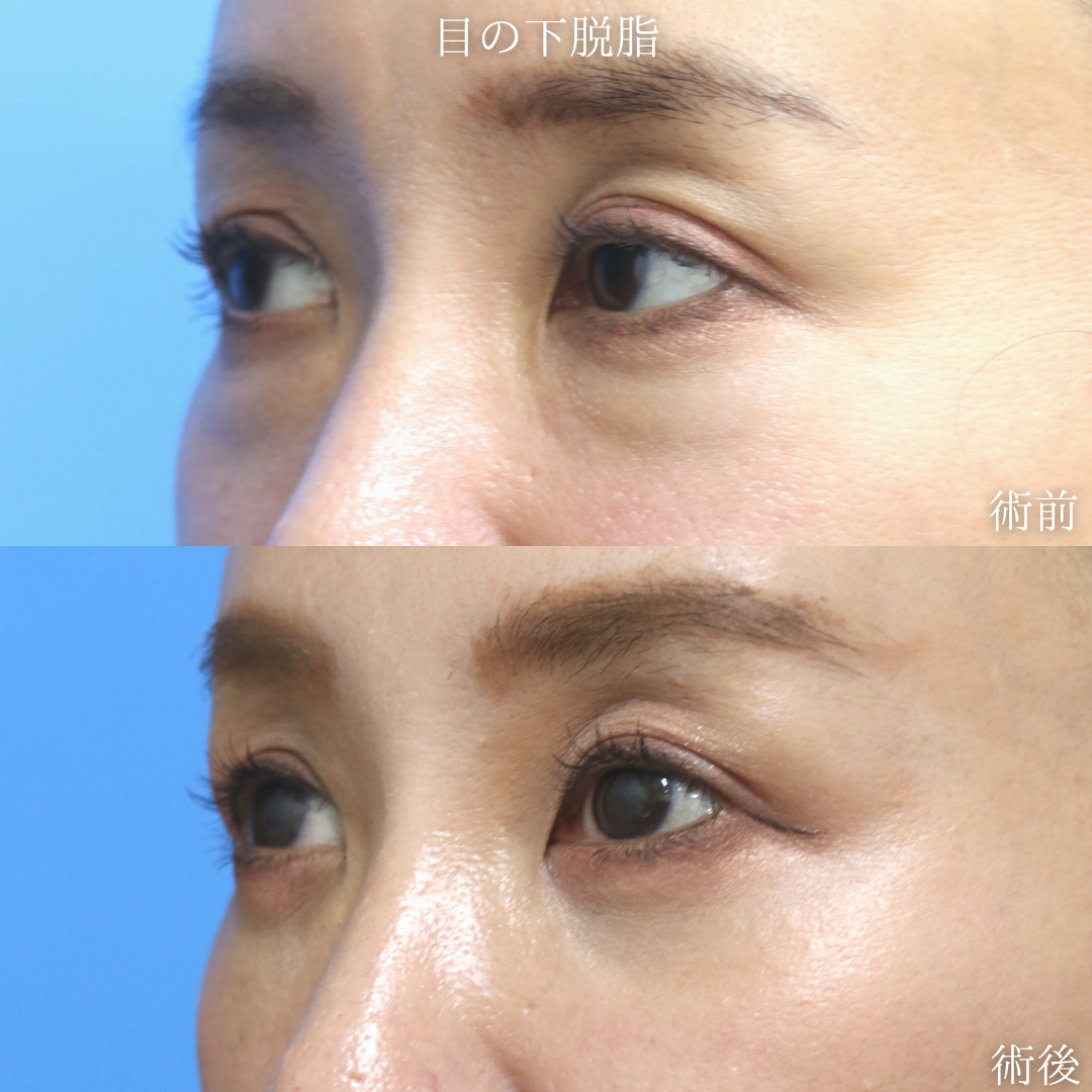 【目の下脱脂】切らないクマ改善を希望　40代女性【症例No.29Y0000973】