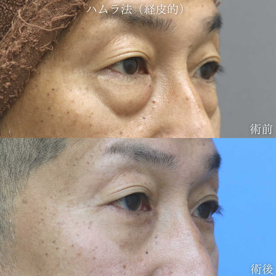 【経皮的ハムラ】目の下のクマに悩む　40代男性【症例No.29Y0000974】