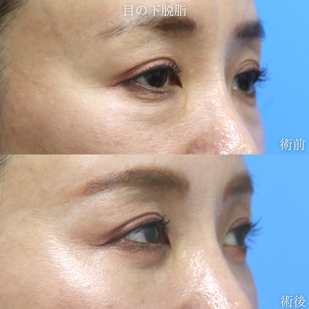 【目の下脱脂】切らないクマ改善を希望　40代女性【症例No.29Y0000973】