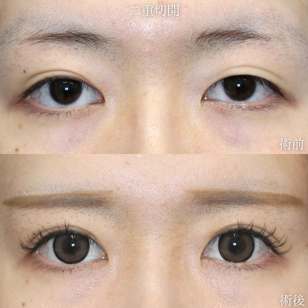 【二重切開】埋没法で作った二重が取れかけている　20代女性【症例No.29Y0000971】