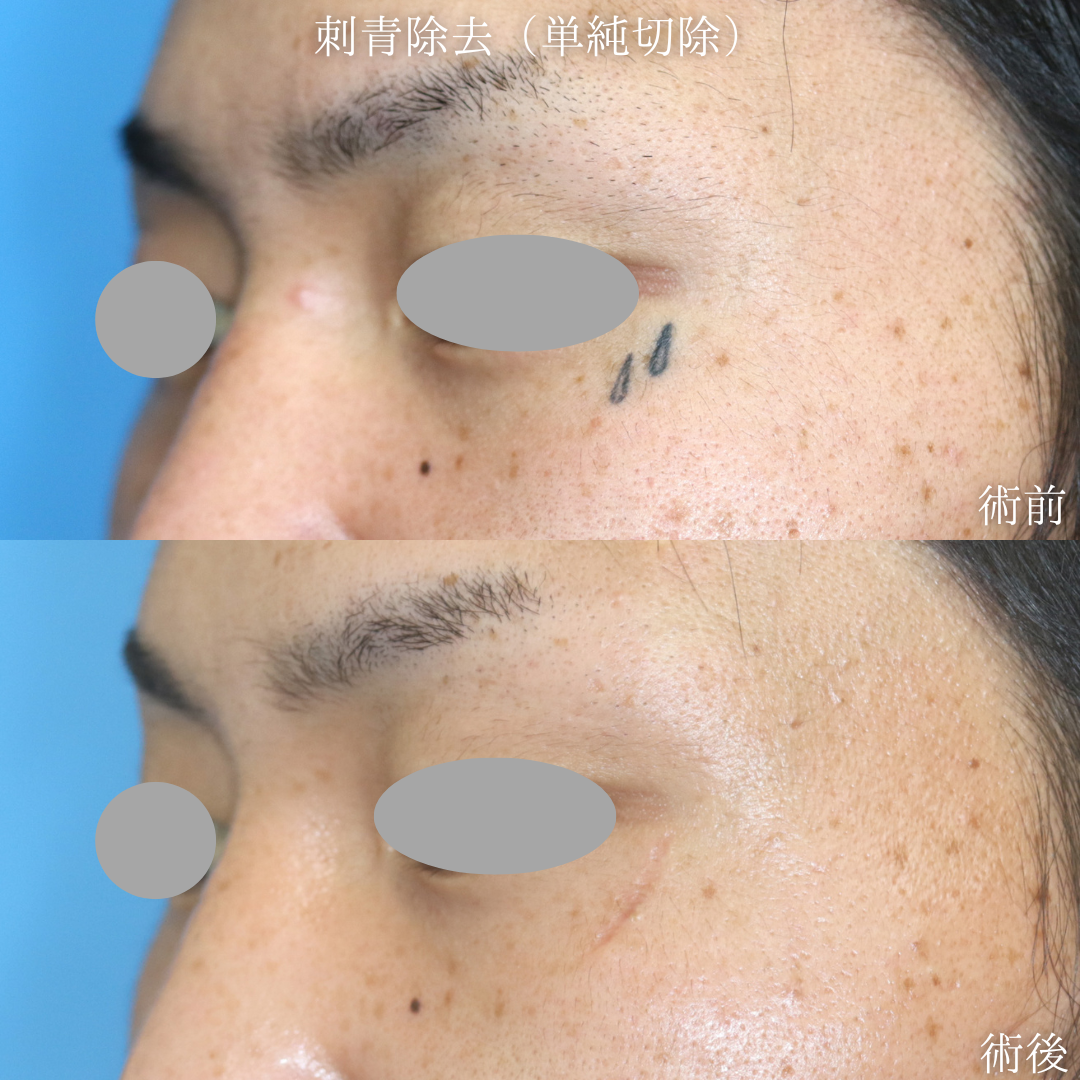 【刺青除去】左下眼瞼に入れたタトゥーを消したい　20代男性【症例No.29Y0000975】
