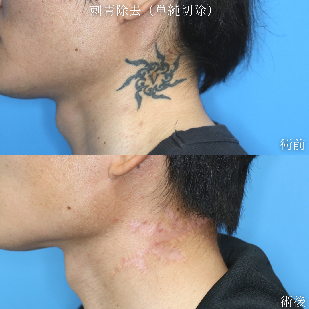 【刺青除去】左頚部に入れたタトゥーを取りたい　20代男性【症例No.29Y0000976】