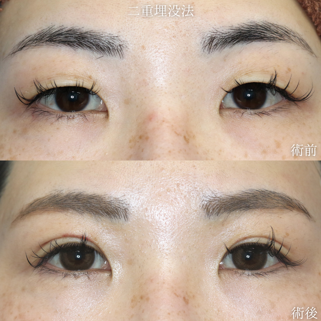 【二重埋没法】一重から末広型の二重に　30代女性【症例No.29Y0000977】