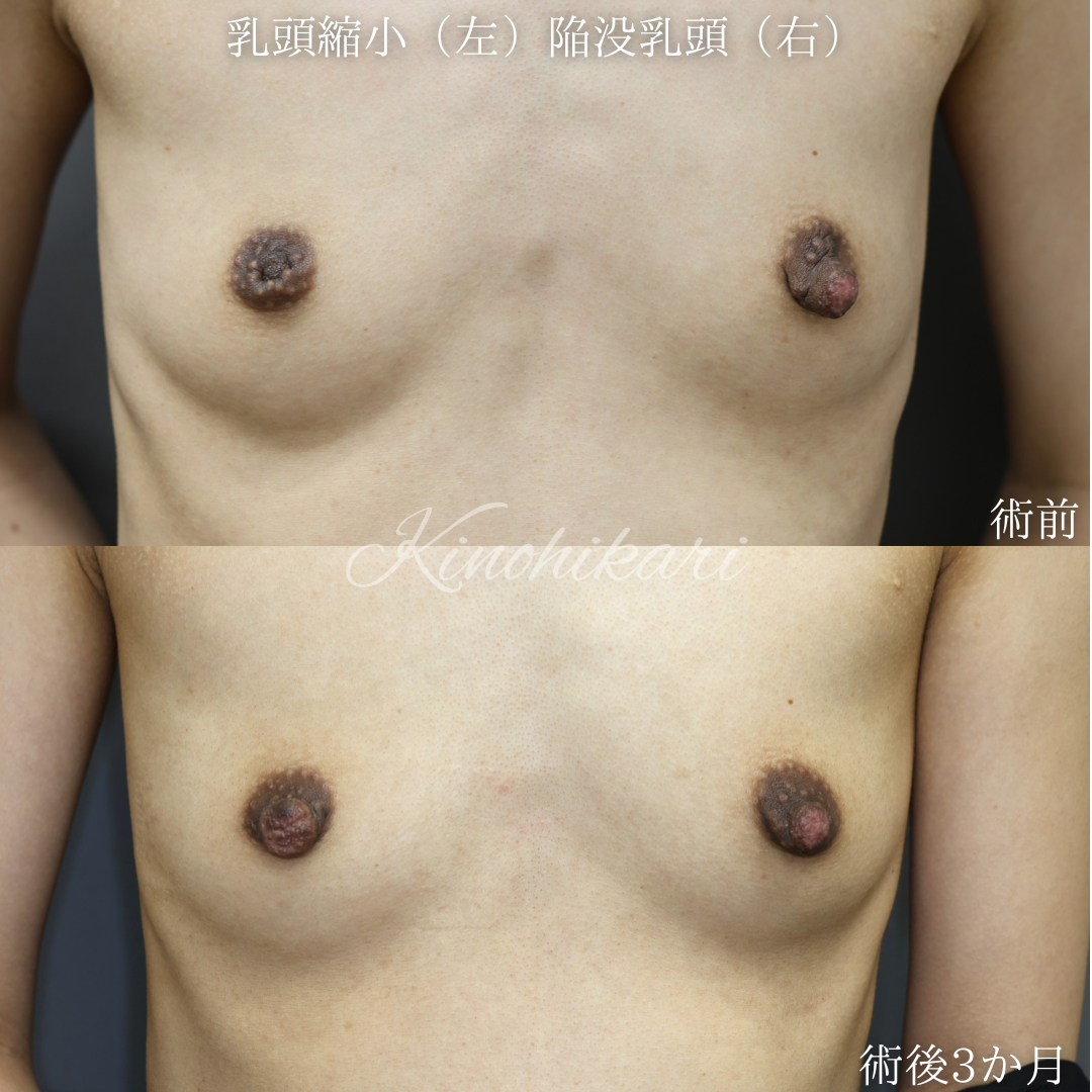 【陥没乳頭、乳頭縮小】左右で違う乳頭の悩みにアプローチ 20代女性【症例No.29T00001011】