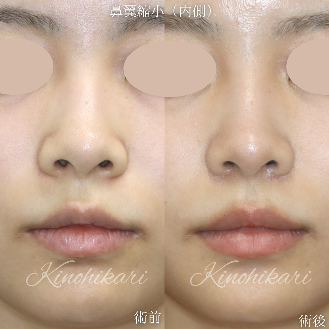 【鼻翼縮小】鼻の穴の大きさを改善したい 20代女性【症例No.29Y00001028】