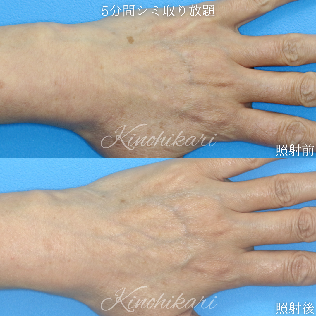 【5分間シミ取り放題】手の甲のシミ取り 50代女性【症例No.29Y00001027】