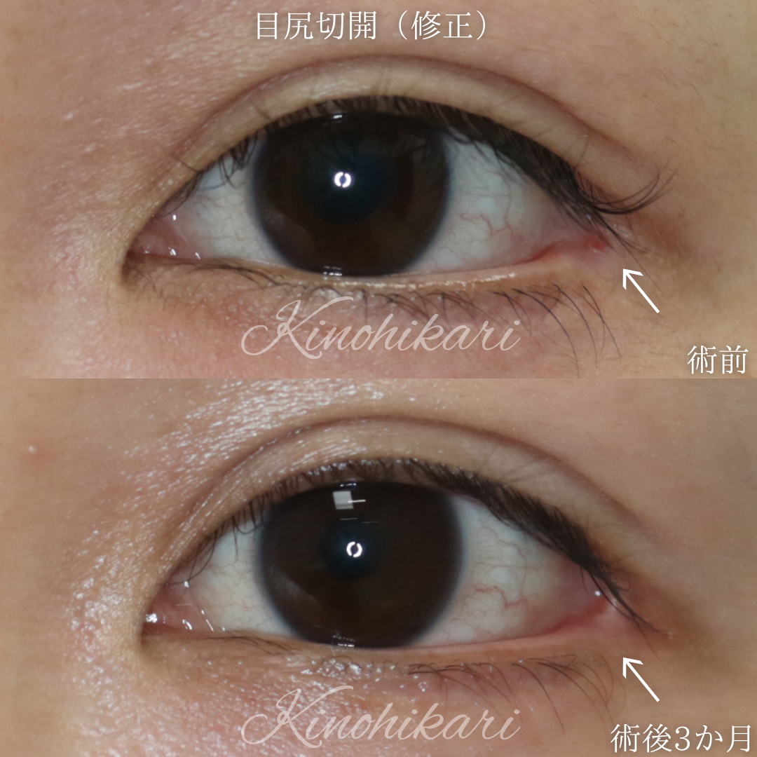 【目尻切開修正】広がりすぎた目尻の開きを戻したい 20代女性【症例No.29Y00001018】