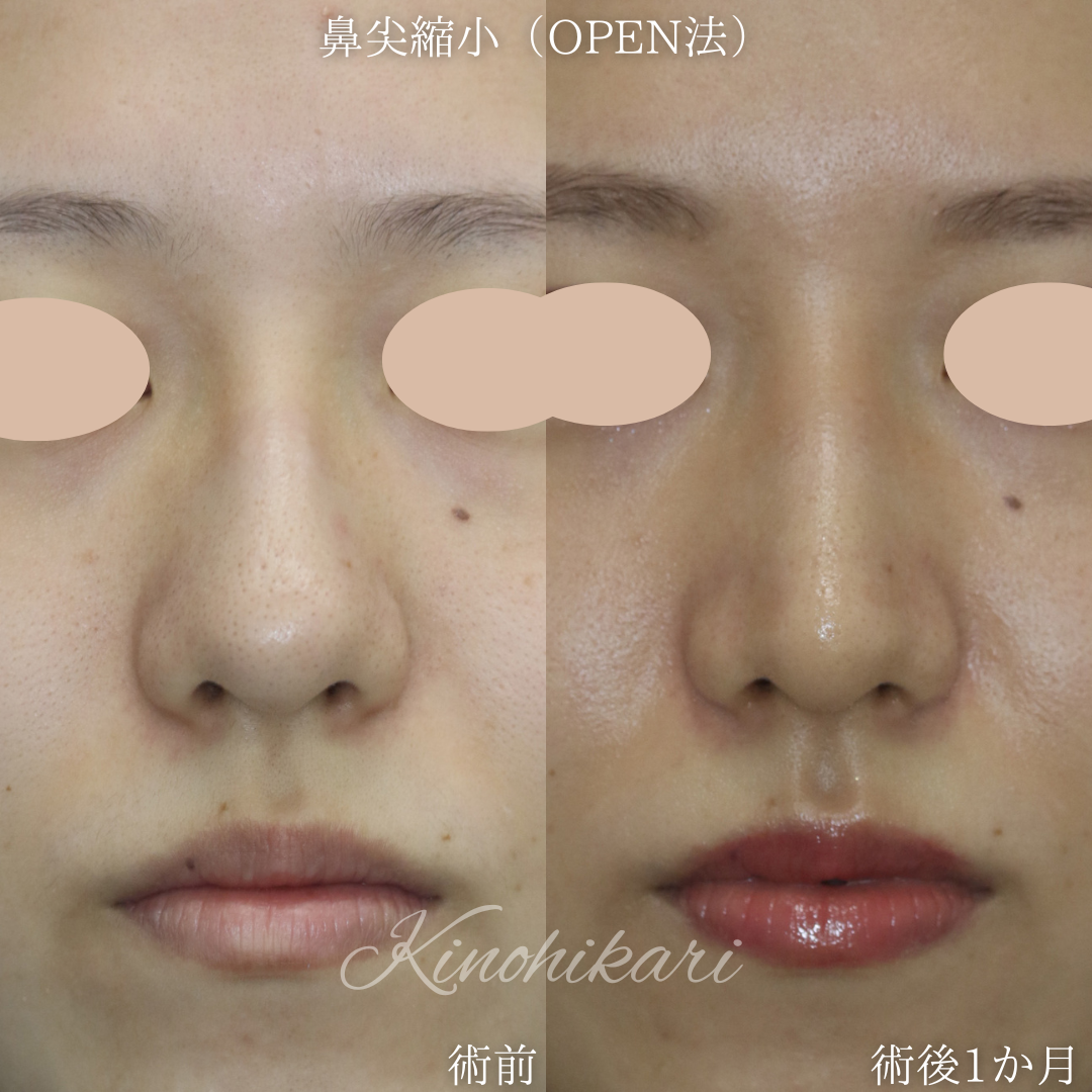 【鼻尖縮小+耳介軟骨移植(OPEN法)】団子鼻をスッキリさせたい20代女性【症例No.29Y00001015】