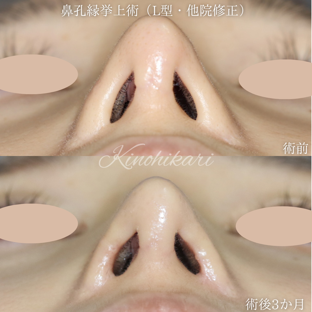 【鼻孔縁挙上術(L型)】小さくなりすぎた鼻孔とその左右差、鼻柱の傷跡を改善したい 20代女性【症例No.29Y00001013 】