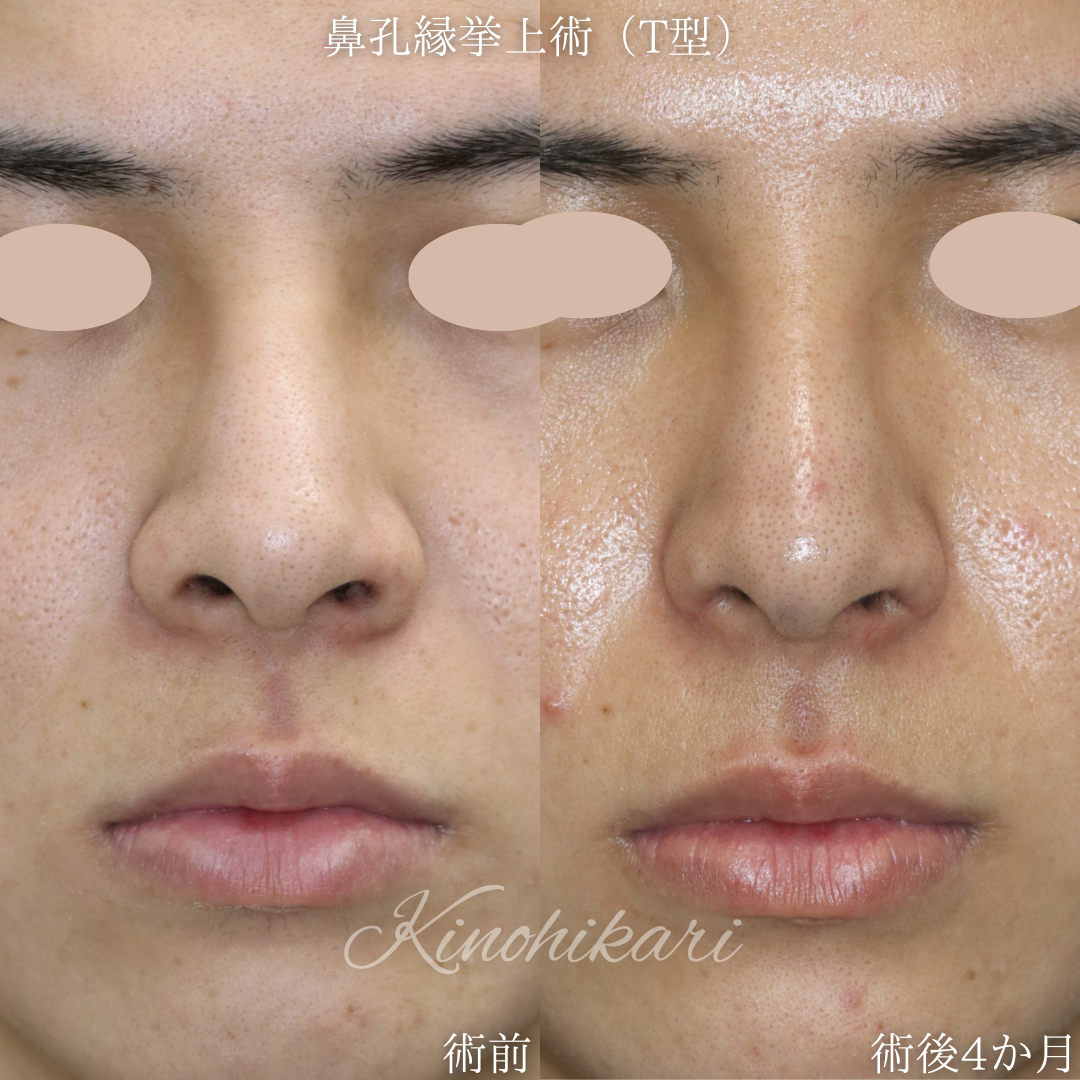 【鼻孔縁挙上術(T型)】張り出した小鼻を小さくしかつ鼻翼の根元を少しだけ上げたい 20代男性【症例No.29Y00001022】