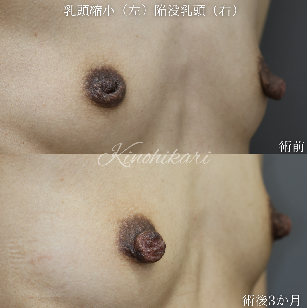【陥没乳頭、乳頭縮小】左右で違う乳頭の悩みにアプローチ 20代女性【症例No.29T00001011】