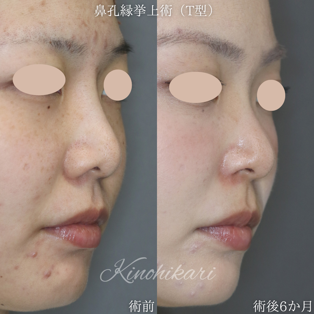【鼻孔縁挙上術(T型)】垂れ下がった小鼻が不自然に見える 20代女性【症例No.29Y00001023】