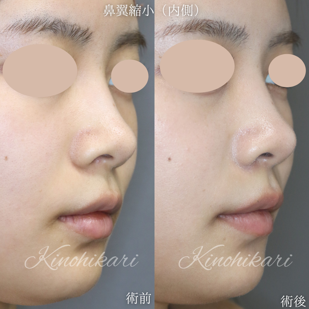 【鼻翼縮小】鼻の穴の大きさを改善したい 20代女性【症例No.29Y00001028】