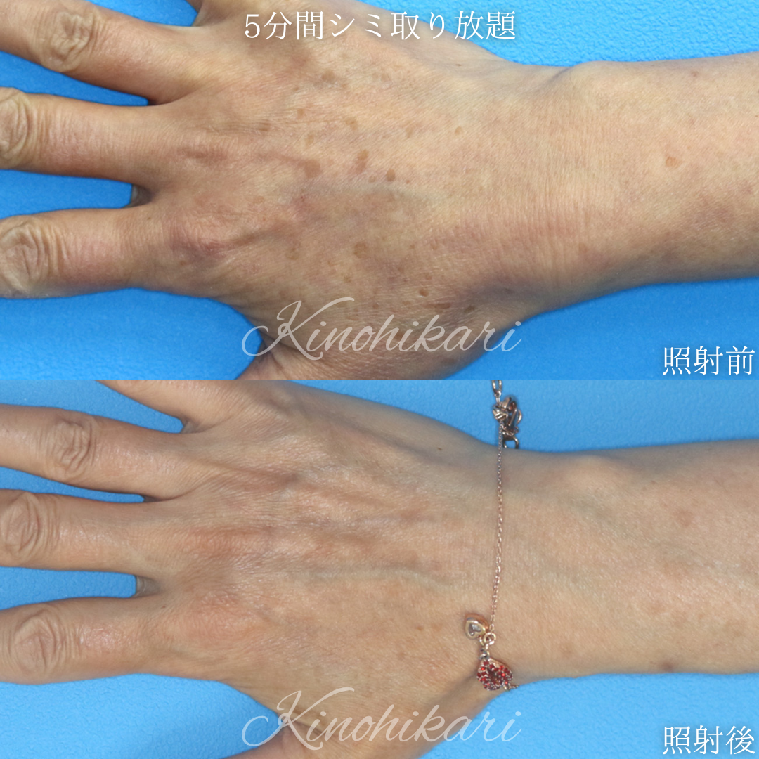 【5分間シミ取り放題】手の甲のシミ取り 50代女性【症例No.29Y00001027】