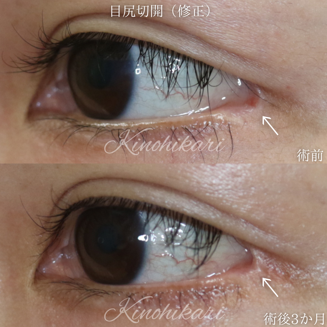 【目尻切開修正】広がりすぎた目尻の開きを戻したい 20代女性【症例No.29Y00001018】