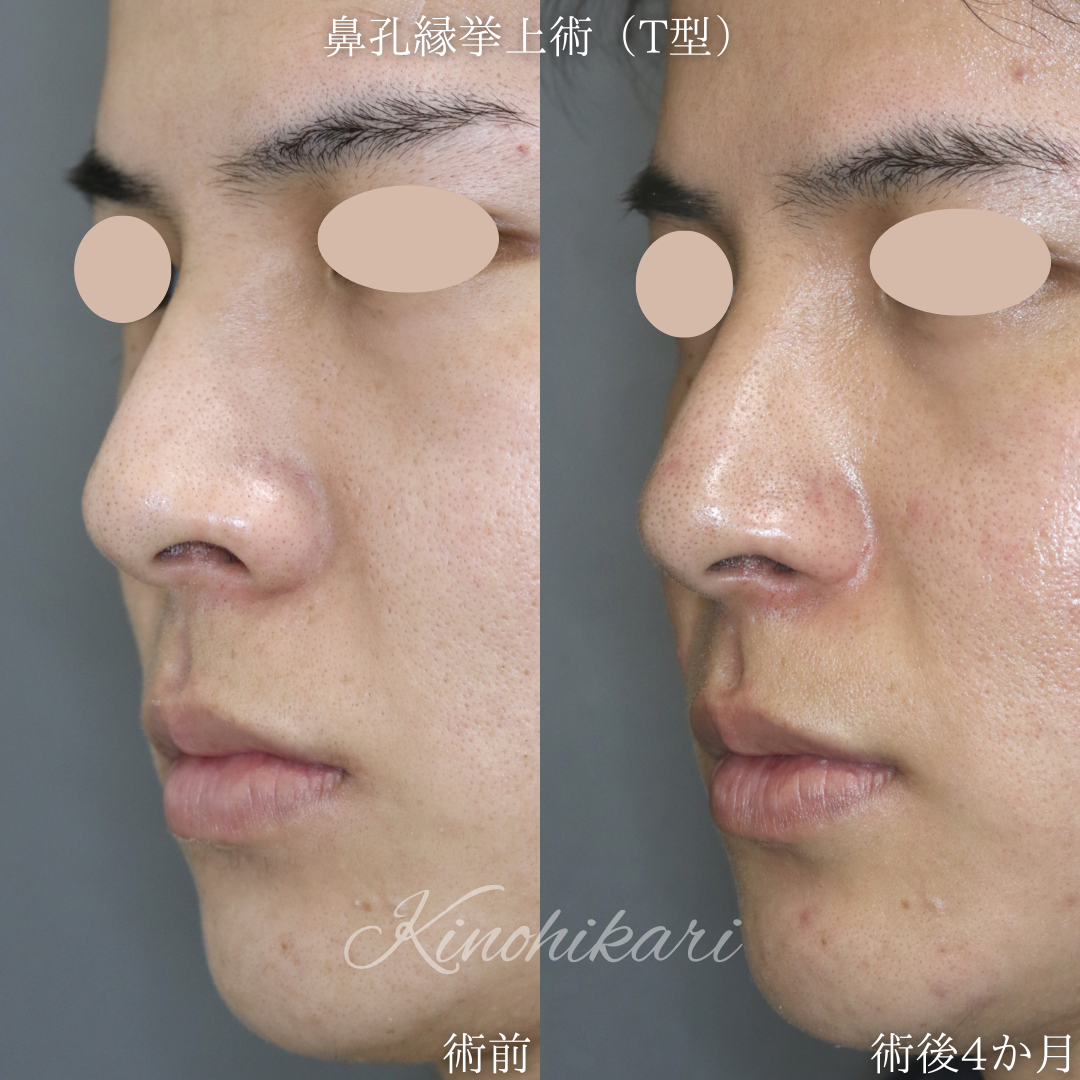 【鼻孔縁挙上術(T型)】張り出した小鼻を小さくしかつ鼻翼の根元を少しだけ上げたい 20代男性【症例No.29Y00001022】