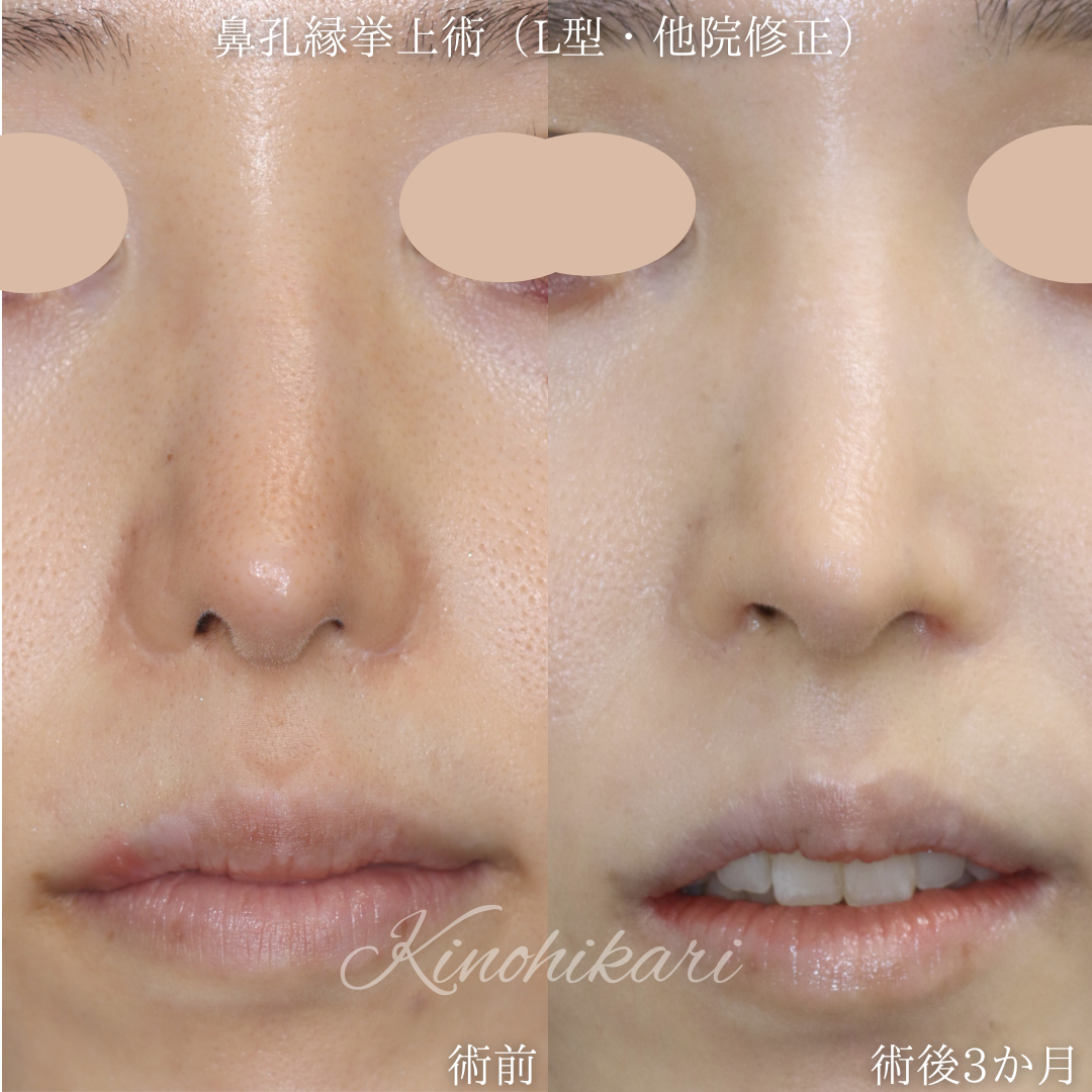 【鼻孔縁挙上術(L型)】小さくなりすぎた鼻孔とその左右差、鼻柱の傷跡を改善したい 20代女性【症例No.29Y00001013 】