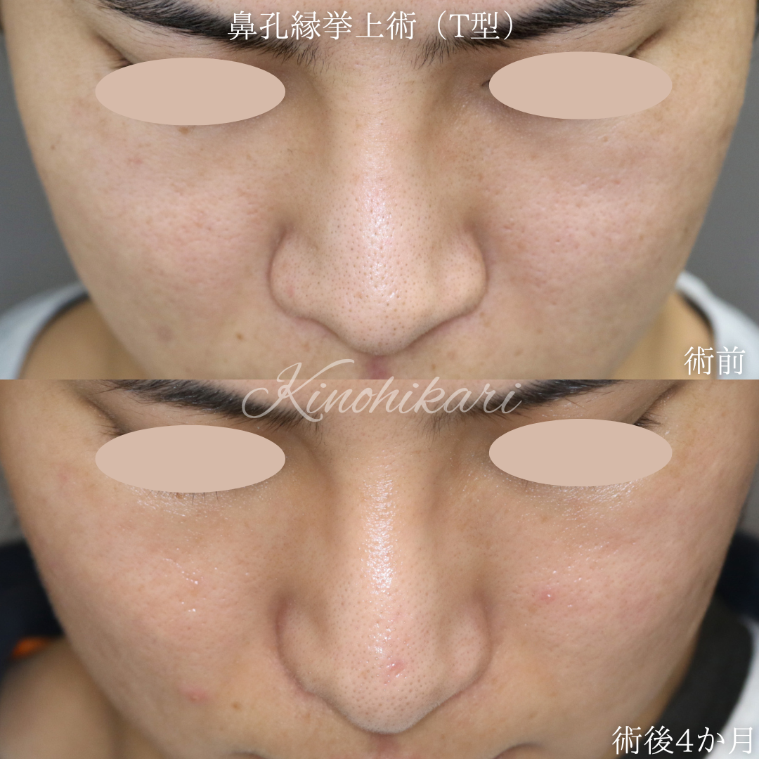 【鼻孔縁挙上術(T型)】張り出した小鼻を小さくしかつ鼻翼の根元を少しだけ上げたい 20代男性【症例No.29Y00001022】