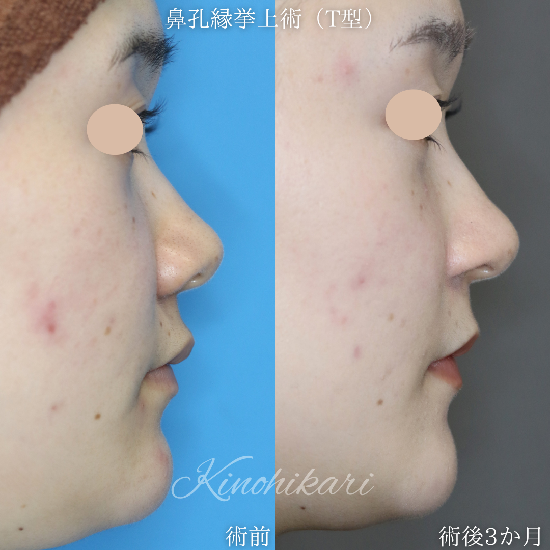 【鼻孔縁挙上術(T型)】大きな小鼻の垂れ下がりを改善したい 20代女性【症例No.29Y000】