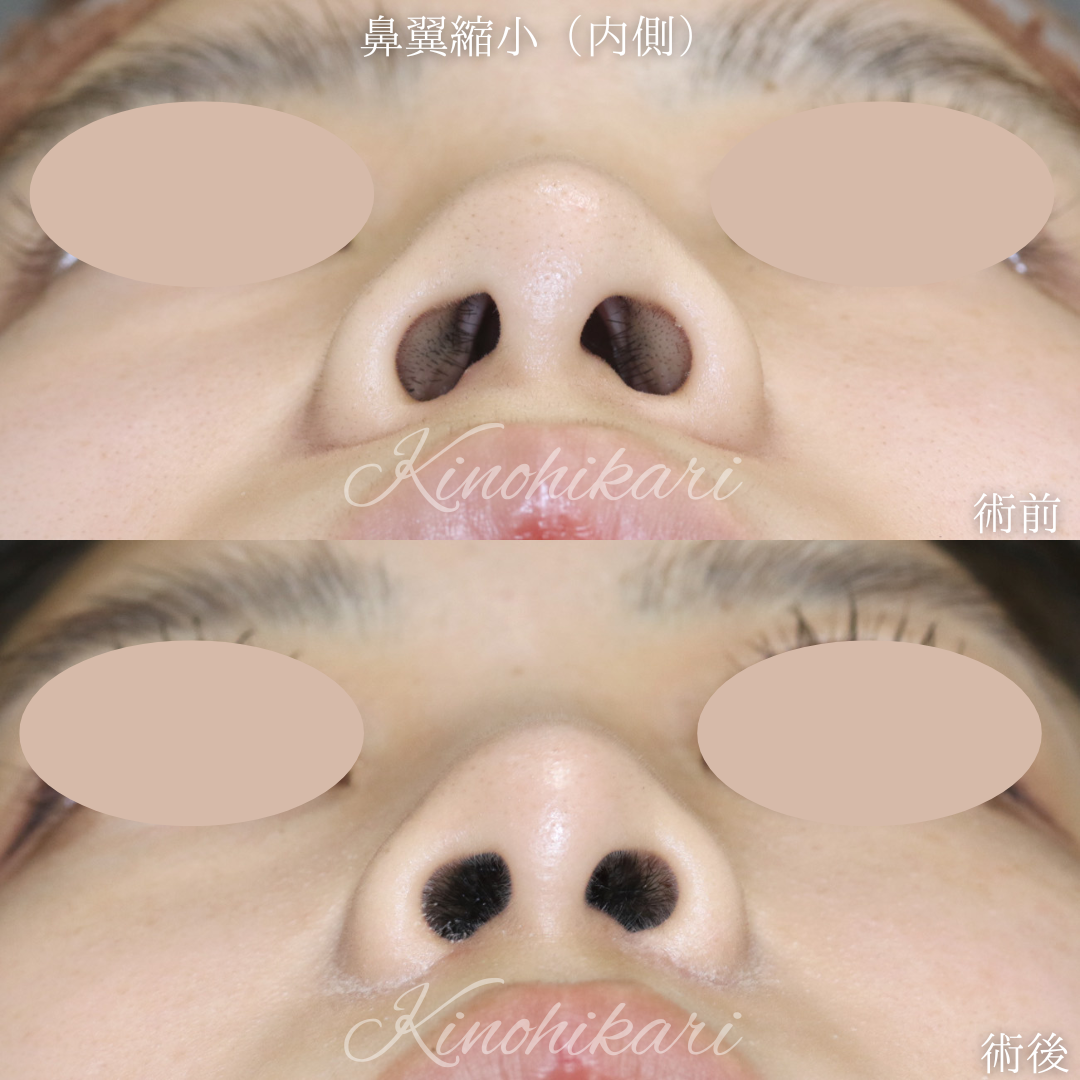 【鼻翼縮小】鼻の穴の大きさを改善したい 20代女性【症例No.29Y00001028】
