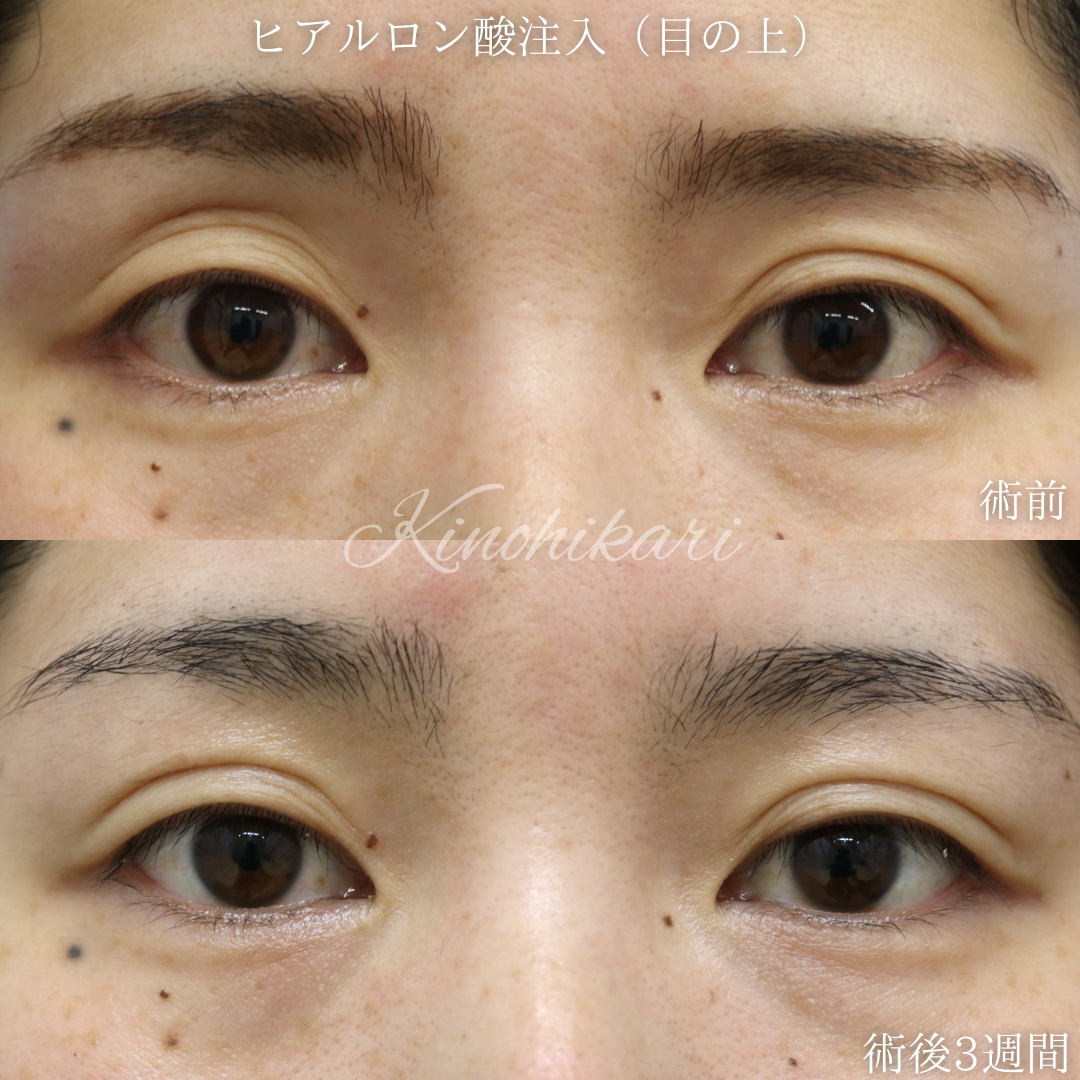 【目の上のくぼみ】目の上の凹みに左右差のある方 30代女性【症例No.29Y00001016】