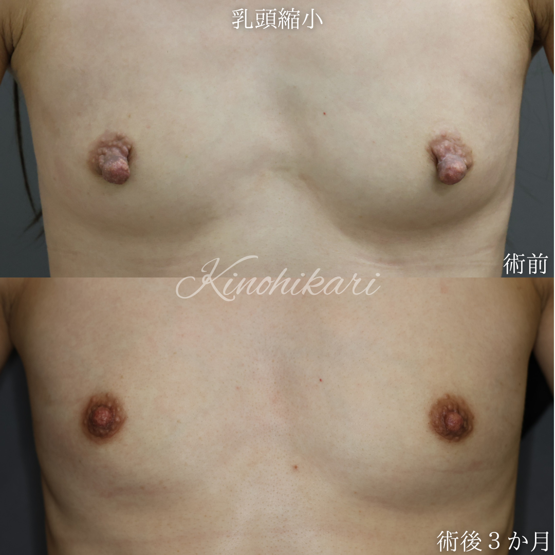【乳頭縮小】乳頭の肥大と垂れ下がりに悩む 30代女性【症例No.29T00001009】