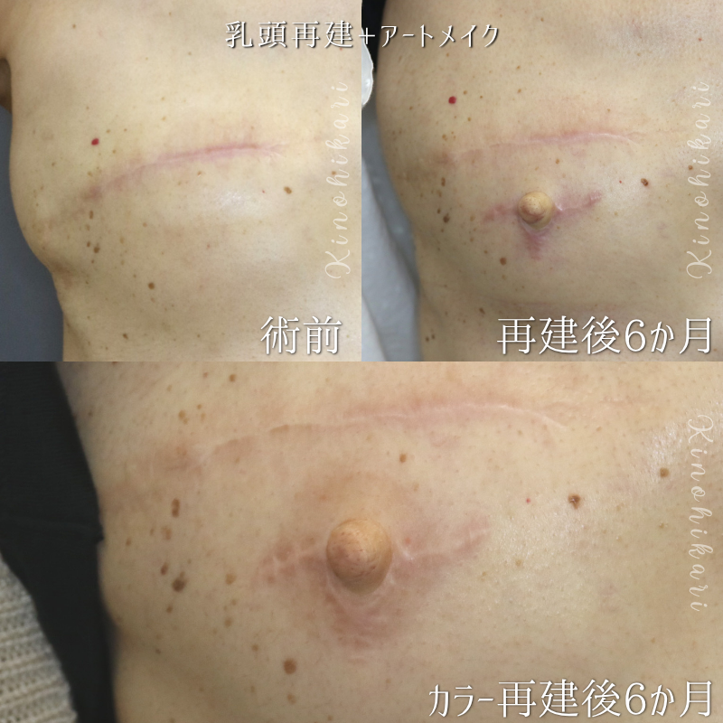 【乳頭再建+アートメイク】乳房再建後の乳房に乳輪・乳頭を再建した一例 50代女性【症例No.29Y00001027】