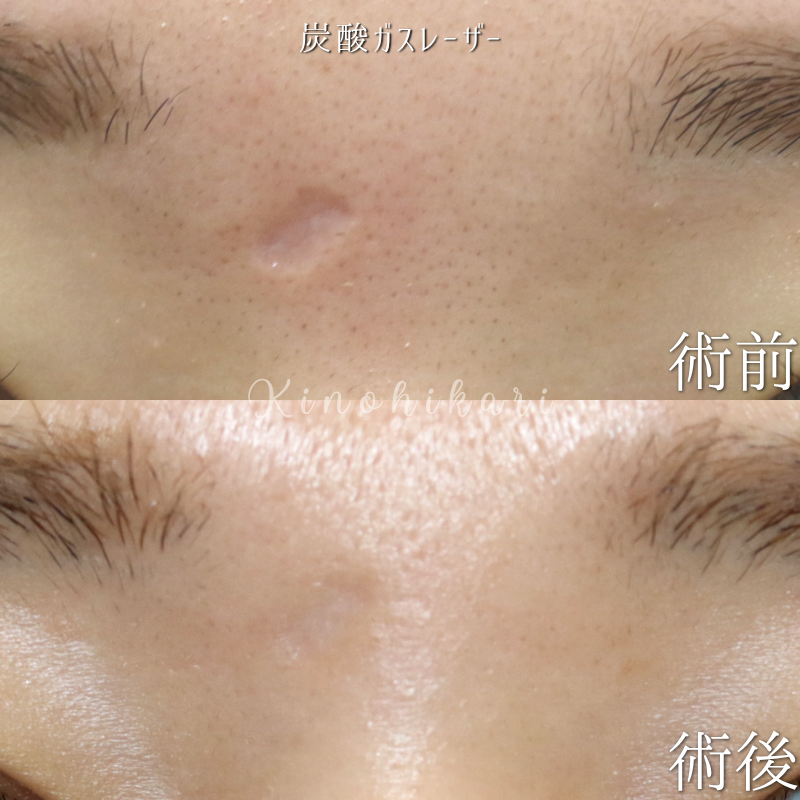 【陥没修正】前額・眉間の陥没変形に対する炭酸ガスレーザー治療　20代女性【症例No.29Y00001021】