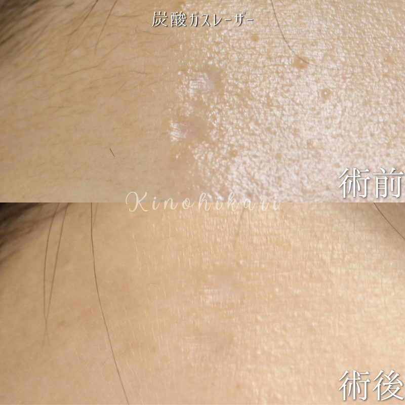 【陥没修正】前額・眉間の陥没変形に対する炭酸ガスレーザー治療 20代女性【症例No.29Y00001021】