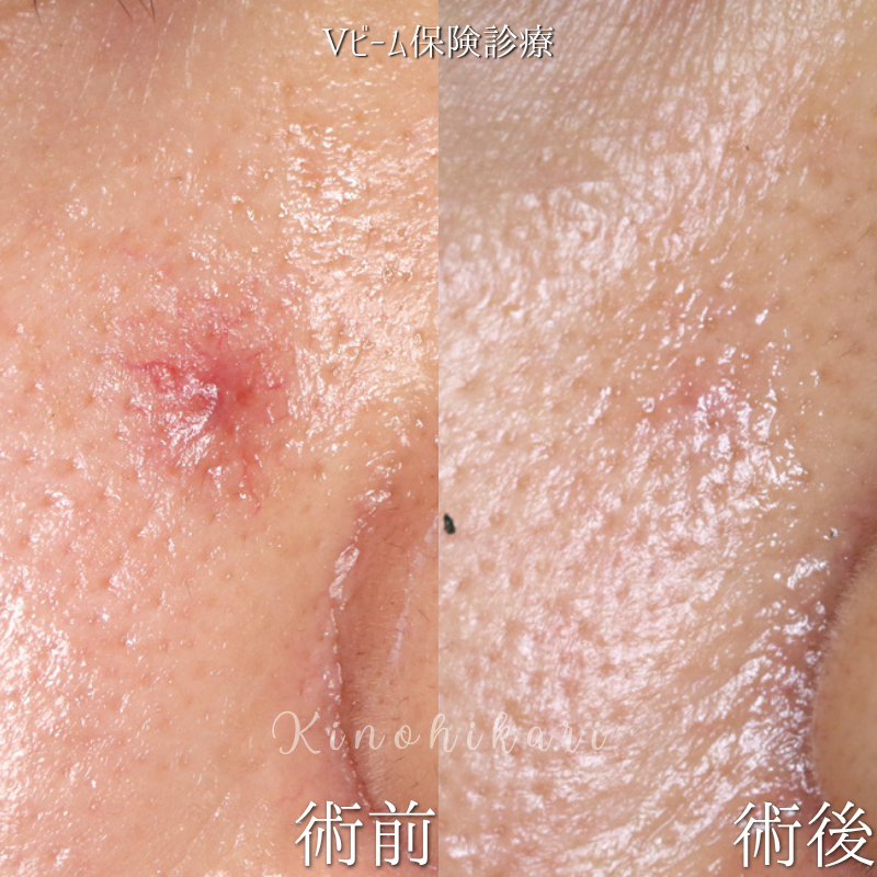 【Vビーム保険診療】右頬の隆起を始めた血管腫を治したい方 30代女性【症例No.29Y00001022】