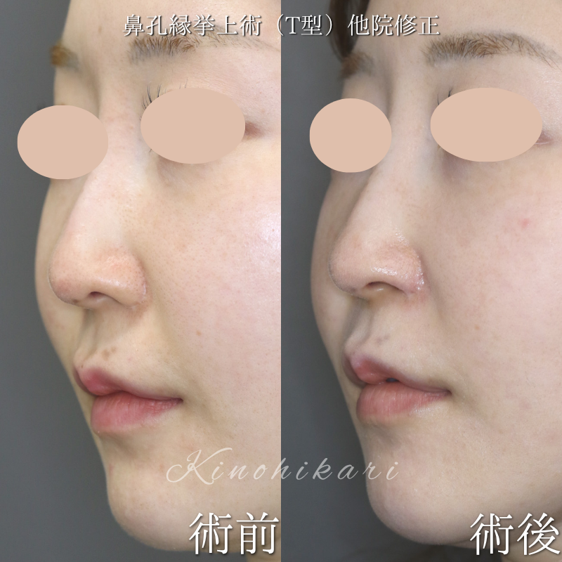【鼻孔縁挙上術(T型)他院修正】鼻翼縮小術の修正、鼻翼の形態を少しだけ変化させたい 30代女性【症例No.29Y00001023】