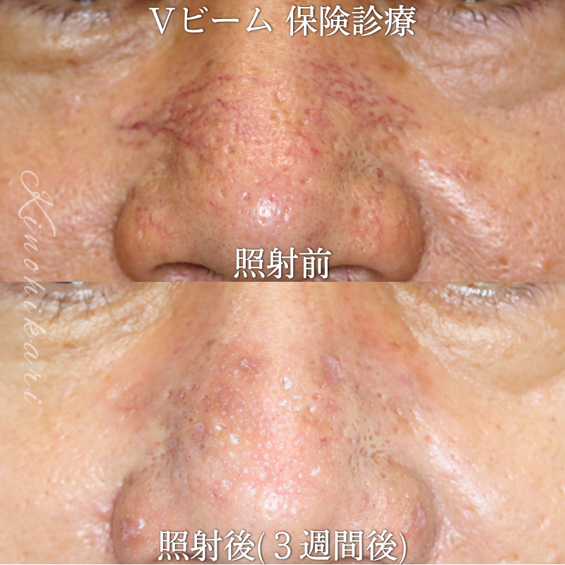 【Vビーム 保険診療】鼻背部の毛細血管拡張症を治したい方【症例No.29YG00001065】