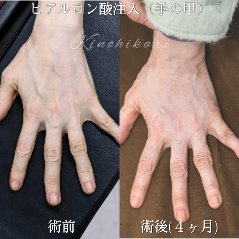 【手の甲ヒアルロン酸注入：ハンドリジュビネーション（手の若返り治療）】年と共に手のエイジングを感じる50代の方【症例No.29Y00001068】
