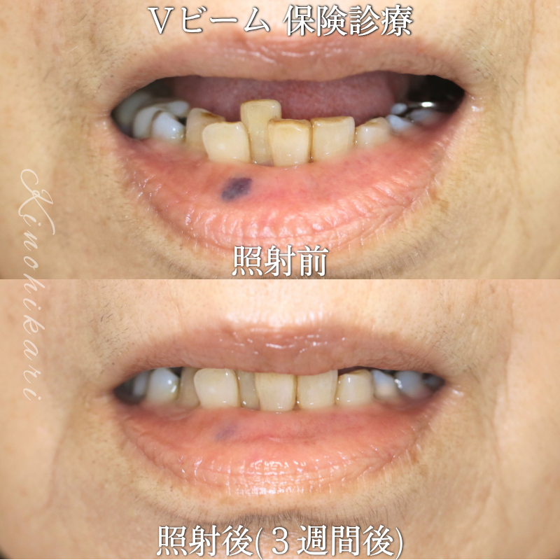 【Vビーム　保険診療】口唇の血管腫を治したい方【症例No.29Y00001066】
