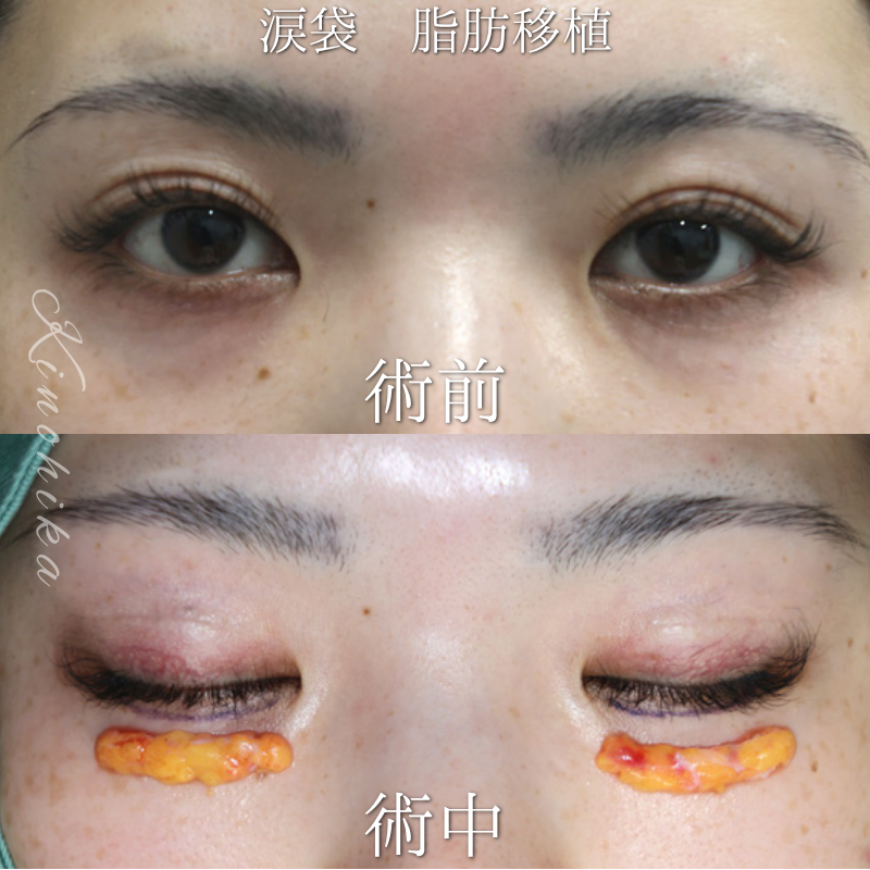 【脂肪移植による涙袋形成】永久的な涙袋が欲しい20代の方【症例No.29Y00001037】